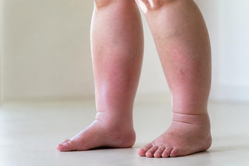découvrez les causes de l'œdème ou edma et comment reconnaître lorsque des jambes gonflées peuvent indiquer un trouble de santé nécessitant une attention médicale.