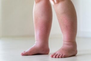 découvrez les causes de l'œdème ou edma et comment reconnaître lorsque des jambes gonflées peuvent indiquer un trouble de santé nécessitant une attention médicale.